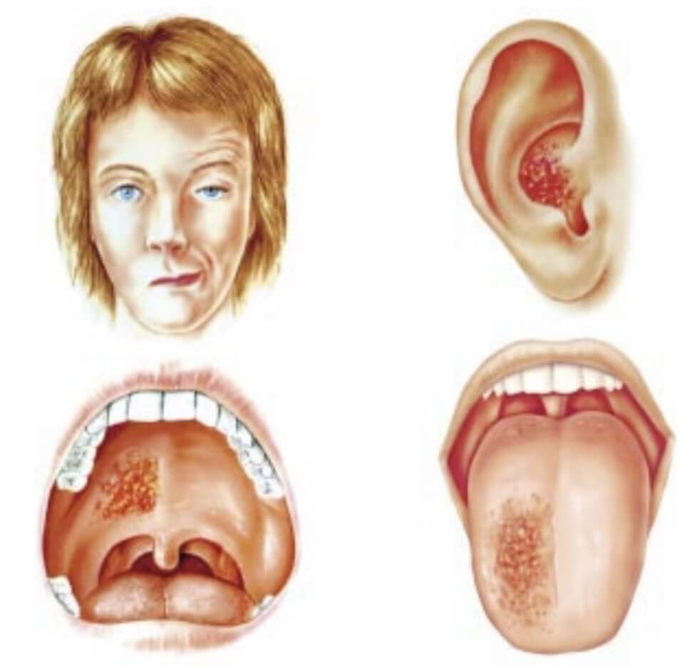 대상포진 초기증상