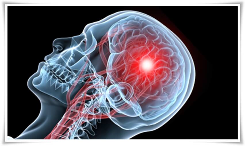 뇌질환 증상 10가지