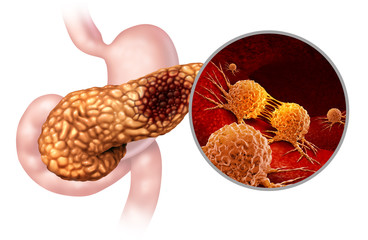 췌장암 초기증상