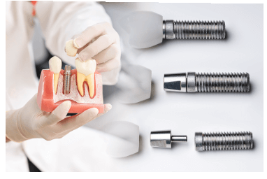 임플란트 시술 6종류