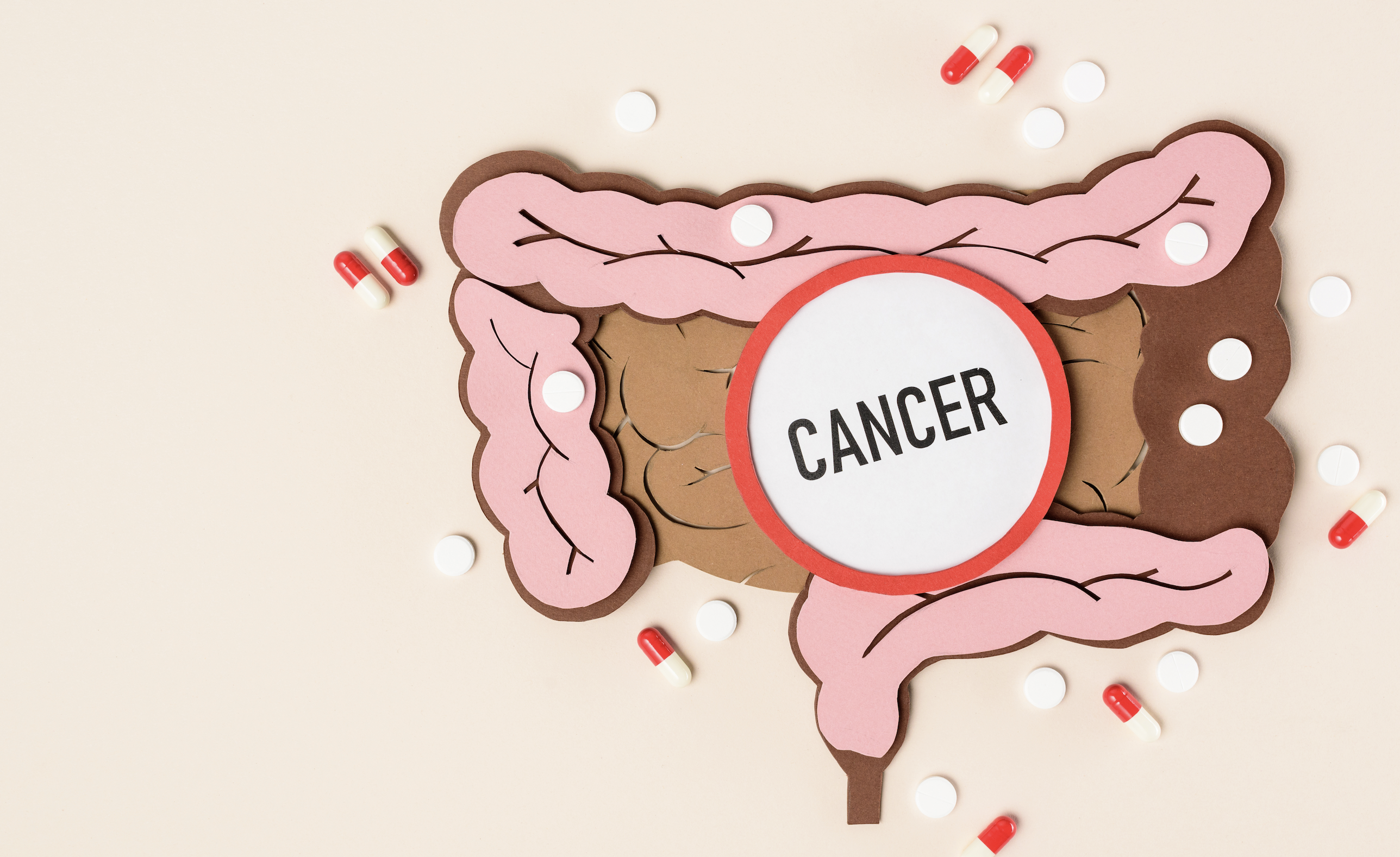 대장암의 원인 및 예방