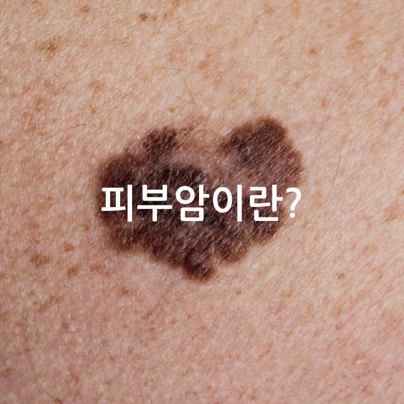 피부암 자가진단법&amp;#44; 피부암 점모양과 초기증상