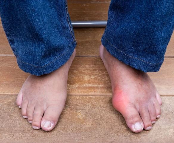 통풍-초기-증상