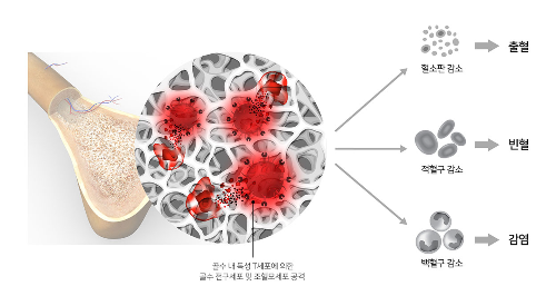 폐암 초기증상