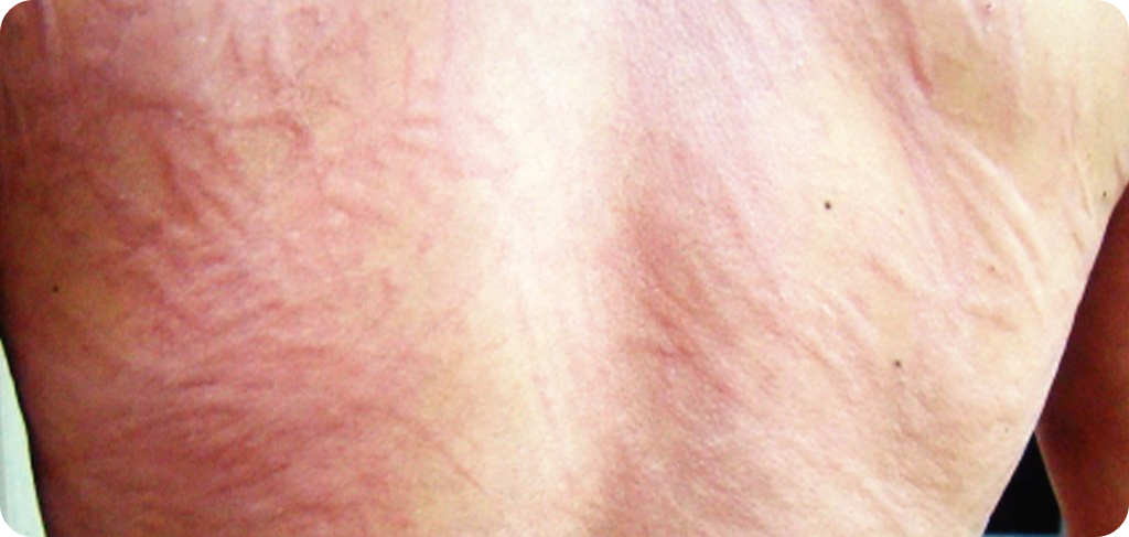 피부-묘기증-증상