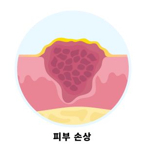 화상 물집 치료방법