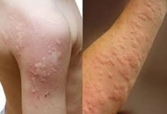 콜린성 알레르기 이미지