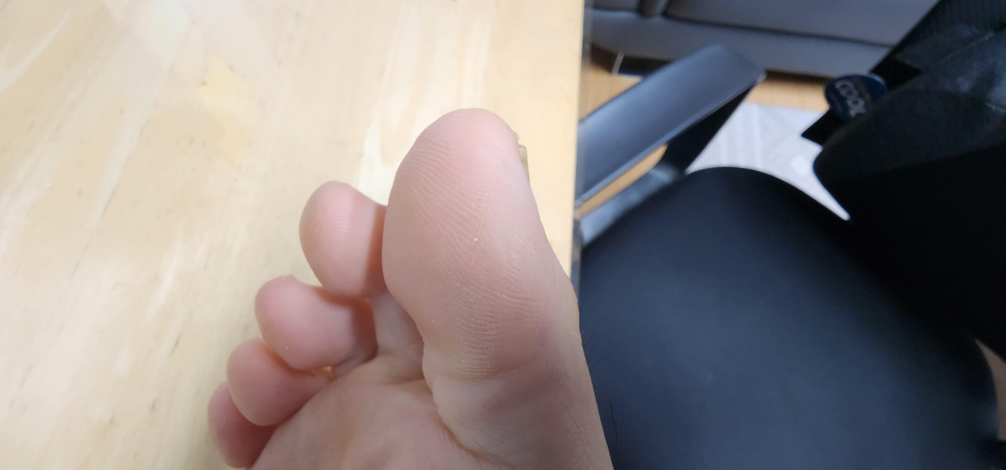 정상으로 돌아온 발가락 사진