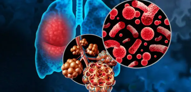 세균성 폐렴과 관련된 사진