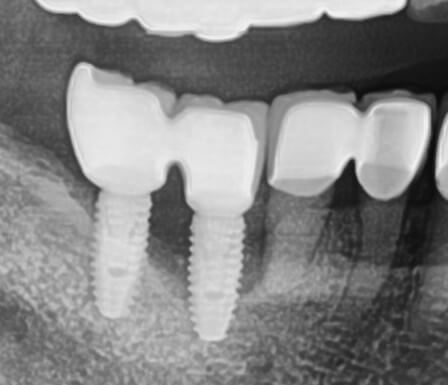 임플란트 보험 임플란트 가격 임플란트 비용 치아 보험 추천 치과 보험 추천 임플란트 치아 보험 치아 보험 적용 기과 보험 적용 치과 보험 임플란트 임플란트 치아