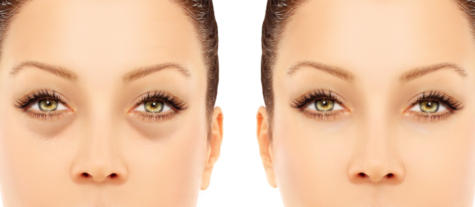 눈밑 하안검 실리프팅: 탄력 있는 눈밑 라인 완성을 위한 시술