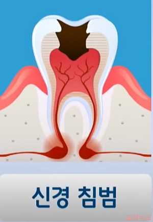 신경 침범한 말기 충치단계_이미지출처:케내네메디컬