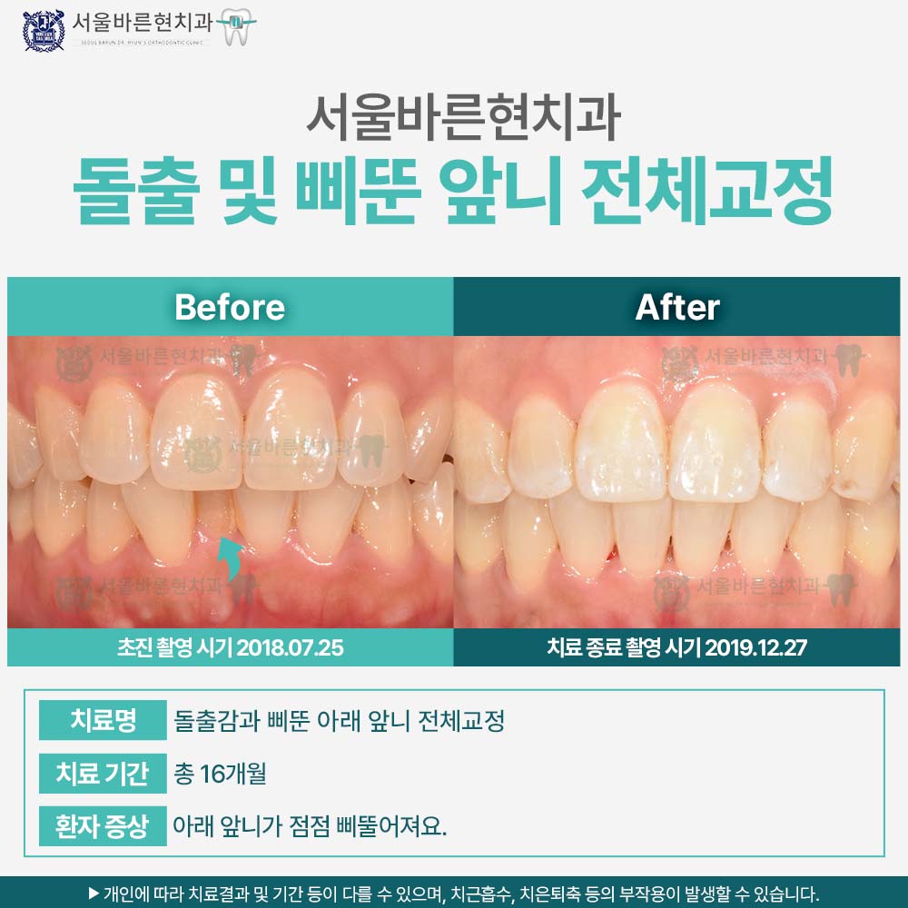 해운대치아교정