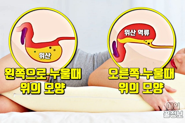 속쓰림,왼쪽으로 누워자면,위안좋을때증상,팁줌