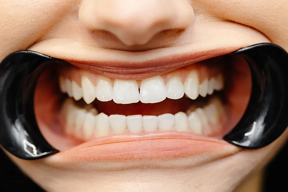 충치가 안 생기는 사람