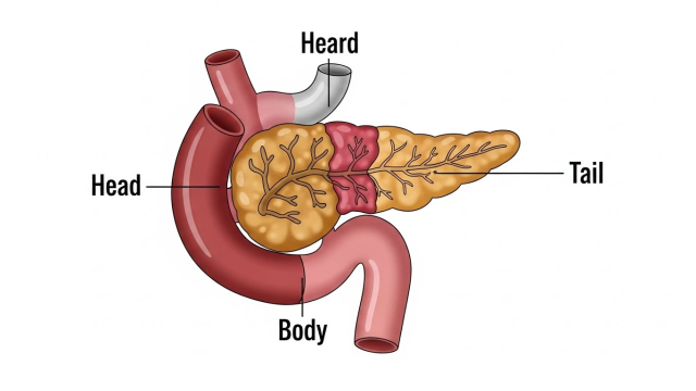 췌장암 초기증상 담도막힘 개념도