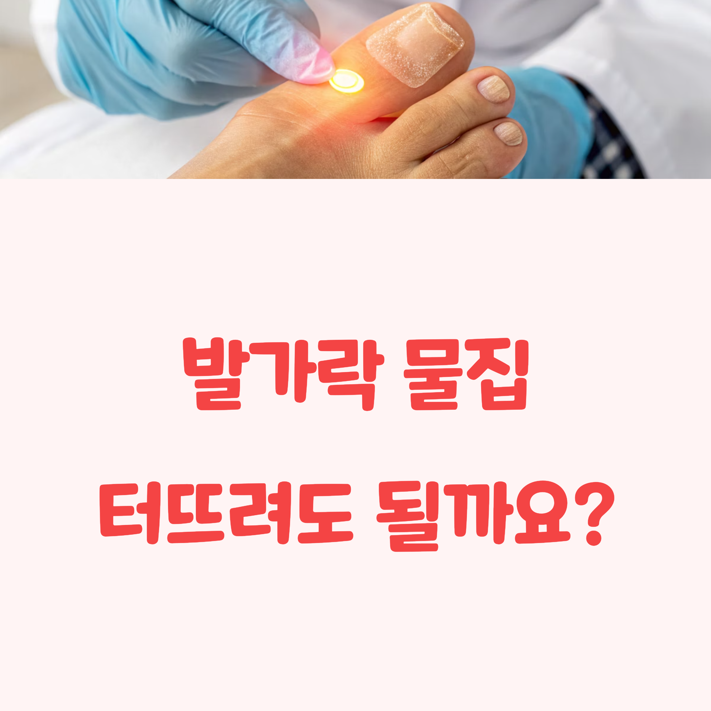 발가락 물집, 터뜨리면 안 되나요?