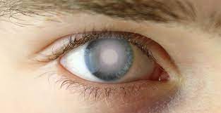 백내장 주의사항