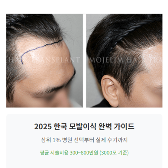 모발이식 3000모 비용