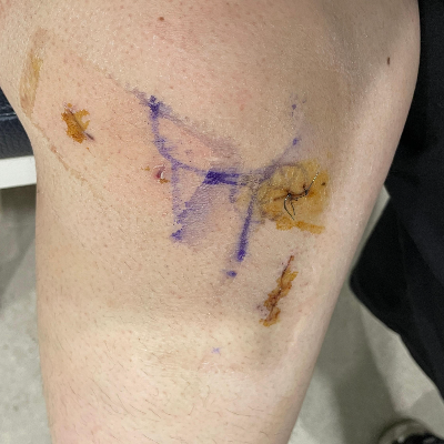 병원에서 실밥 뽑을 때