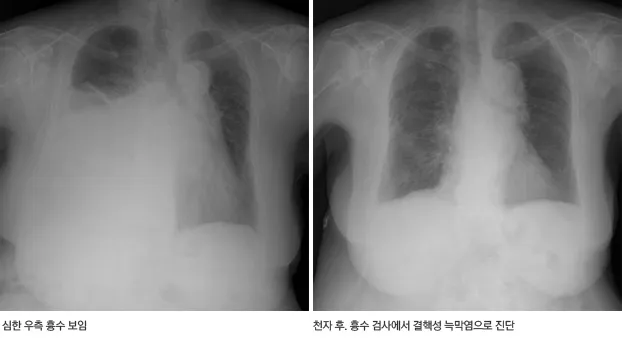 폐에 물이 차는 원인 증상 물참 관리 포인트에 대한 건강정보_2