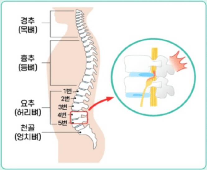 허리디스크 4번5번 위치