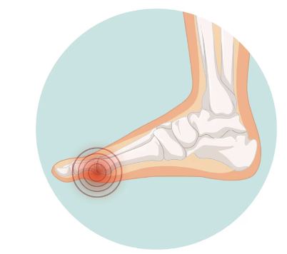 통풍 빨리 낫는 방법