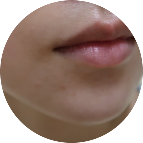 bbl 레이저 후기