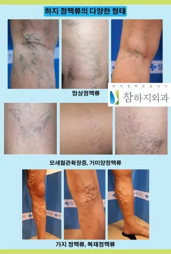 하지 정맥류 증상 치료방법과 예방 생활습관_18