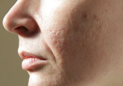 팔자주름 생기는 원인