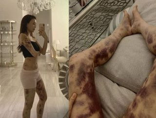 아옳이 병원 건강주사 승소