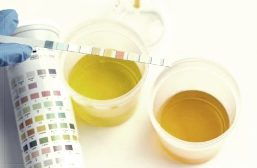 주황색 소변에서 노란색 소변까지: 색깔로 알아보는 건강체크
