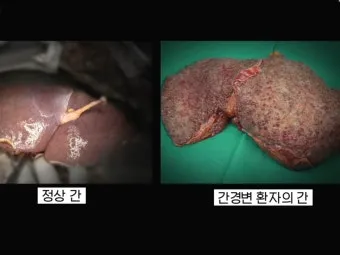 비알콜성 지방간 없애는 방법 운동 식단 중심 회복법 정리_16