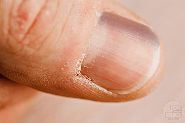 손톱 색깔 건강 손톱색깔 검은색 흑색종 피부암