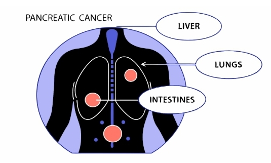 췌장암 원인과 의심증상
