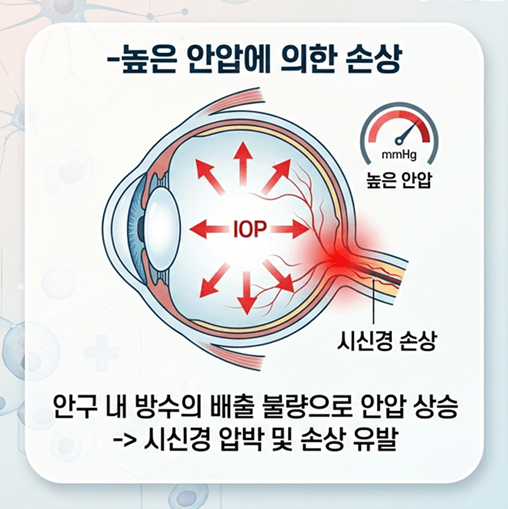 녹내장 원인