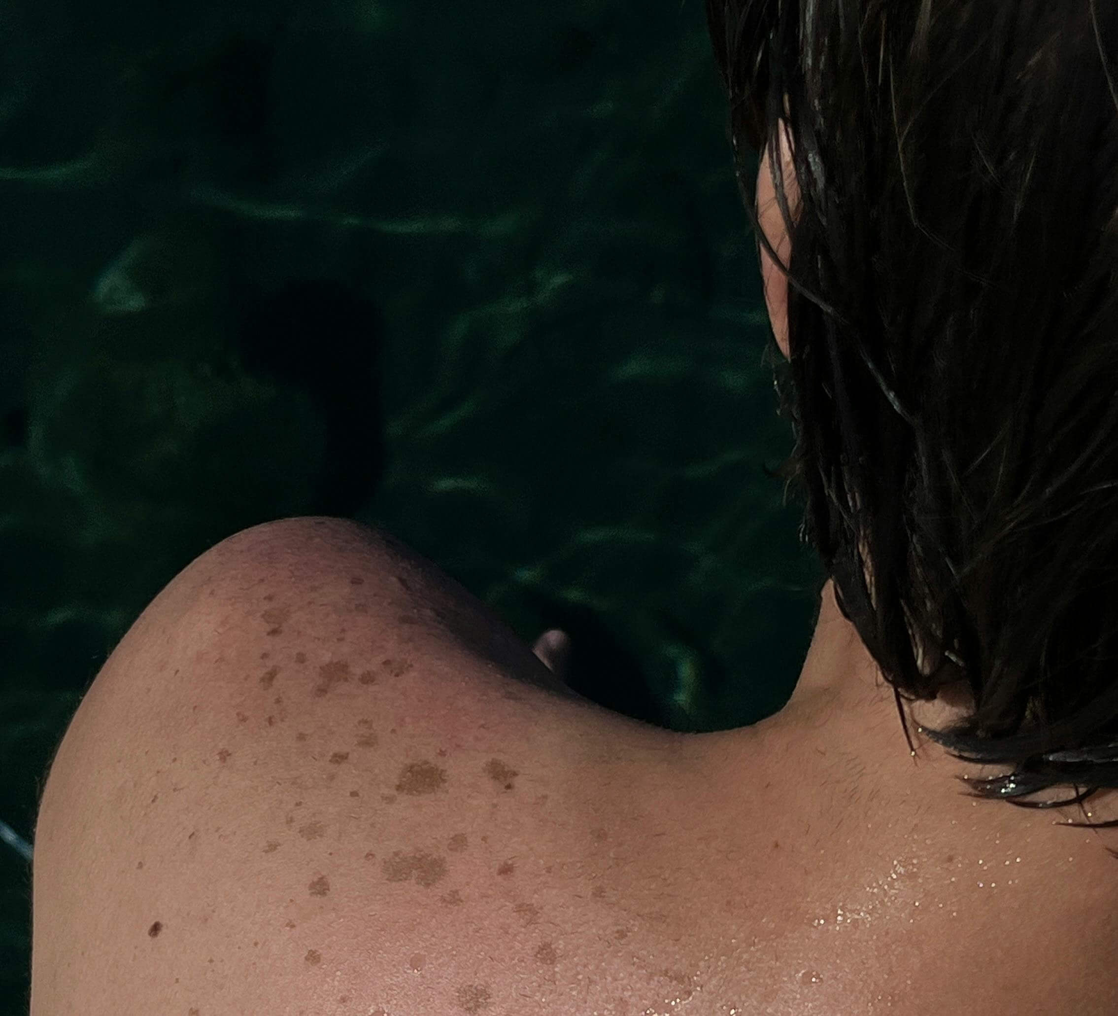 기미&middot;주근깨&middot;검버섯 원인