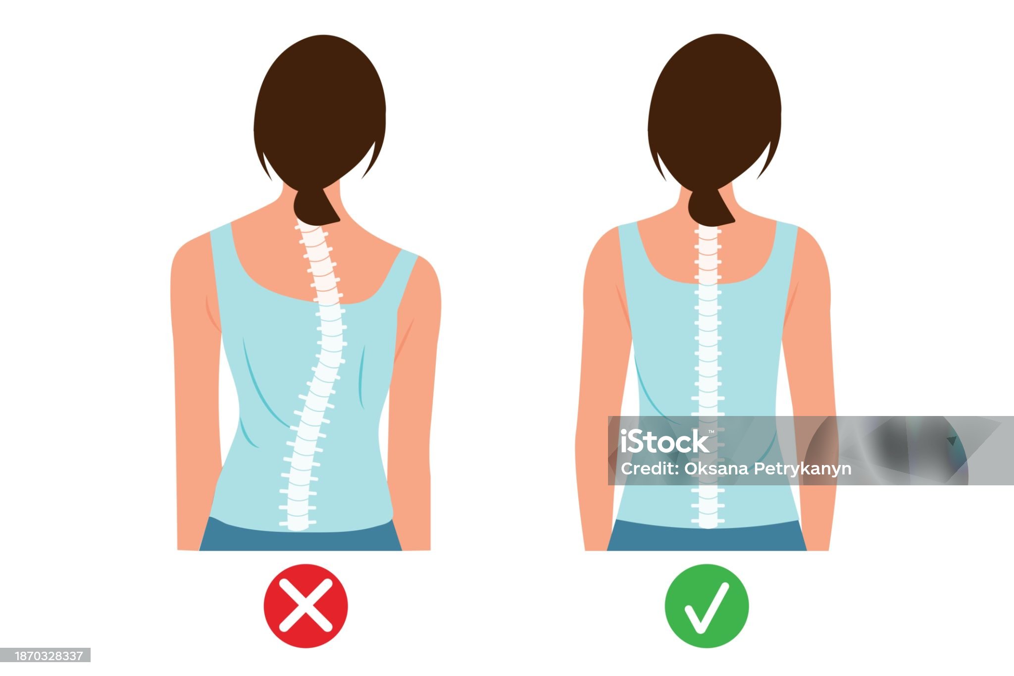 척추측만증-관련-사진