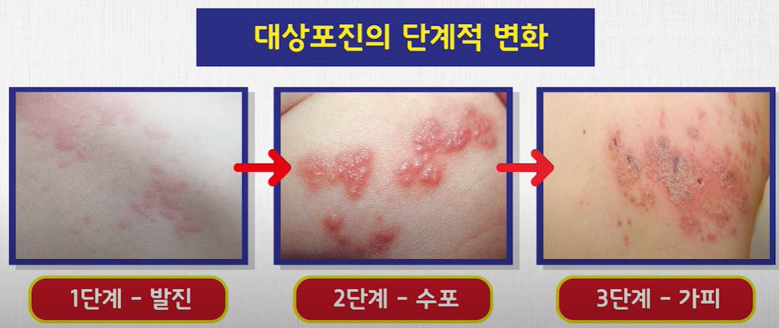 대상포진 초기증상