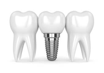 임플란트 건강보험 적용