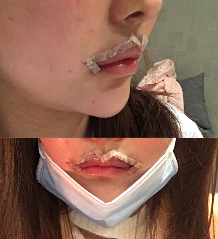 입술확대수술
