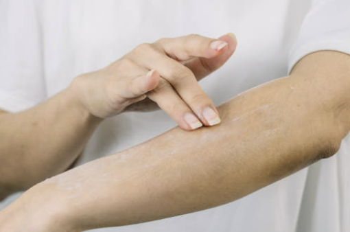 피부건조증 증상, 치료법, 좋은 음식과 연고 등 소개