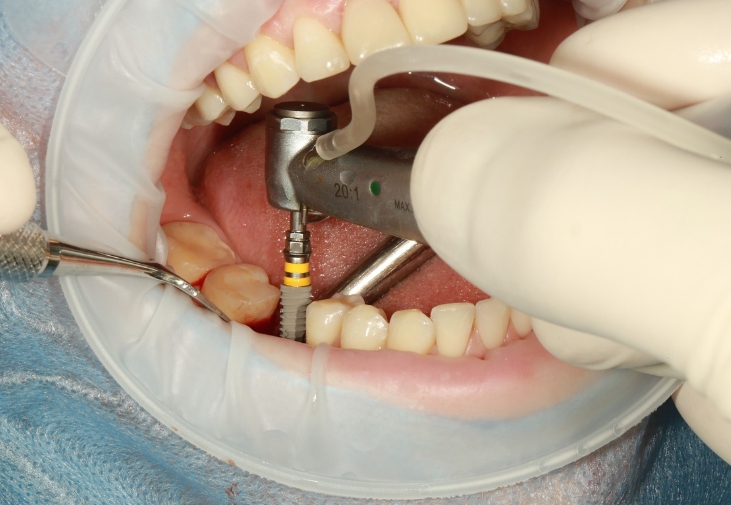 임플란트는 치아 건강을 위한 선택