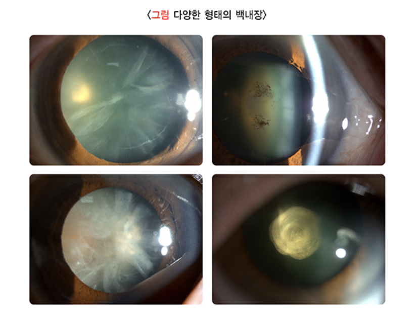 백내장