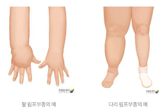림프부종 사진