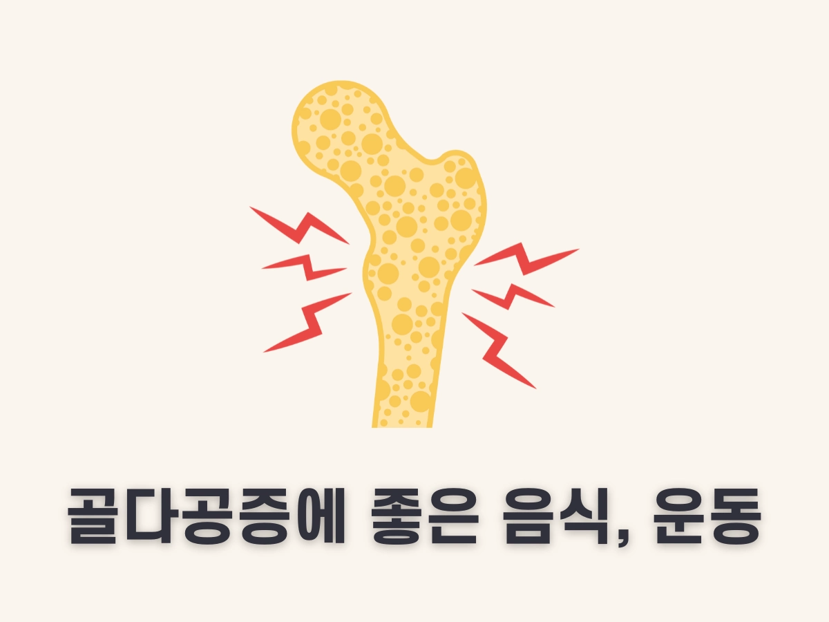 골다공증에 좋은 음식 및 운동
