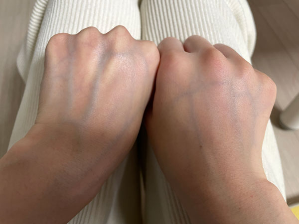 대상포진 초기증상 사진 - 오른쪽 손등 부기