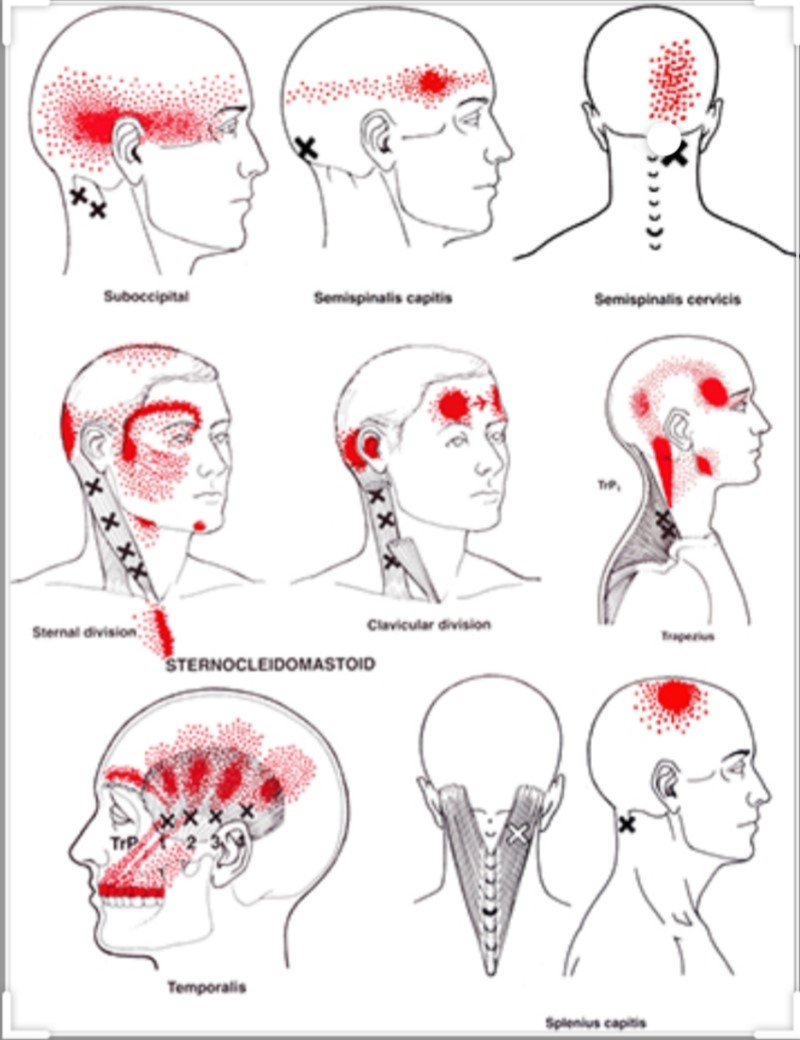 긴장성두통-편두통-증상-원인-치료법-해결법