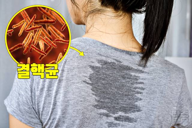 땀 많이 나는 병 다한증 원인 결핵