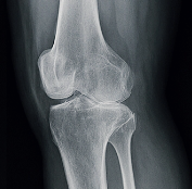 무릎 연골 손상 증상